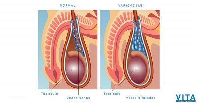 varicocele que es