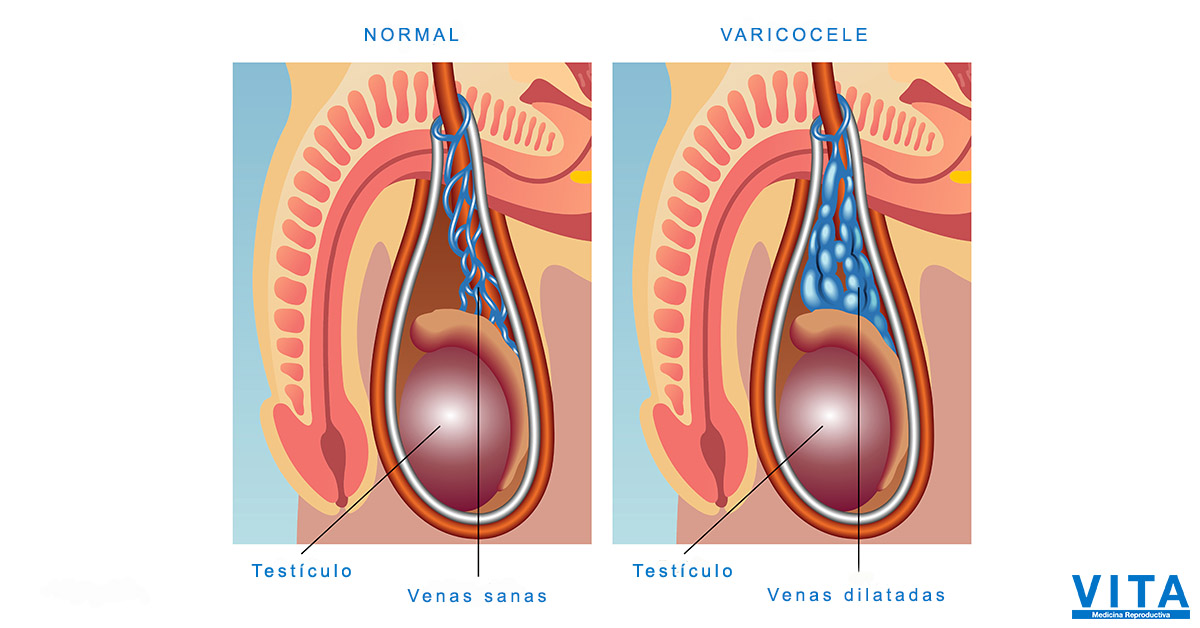 Varicose seal viena - Care sunt venele varicoase ale frânghiei de semine