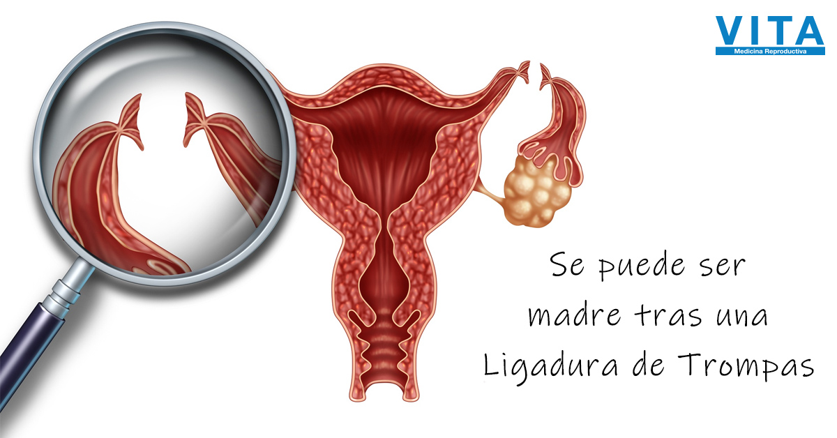 Isaac educador Madurar Ser madre tras una ligadura de trompas es posible - VITA Medicina  Reproductiva