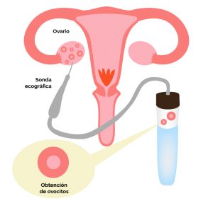 en-qué-consiste-la-punción-ovárica