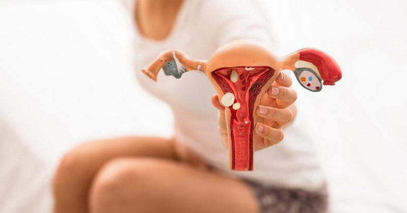 que significa endometriosis ovarica